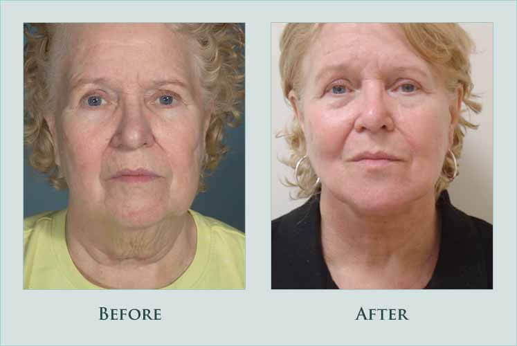 face necklift case before after picture