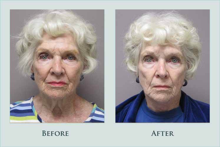 Before/after photos of procedure performed by Dr. Caroline Min - This is an 80 year old woman who was unhappy with the appearance of loose hanging skin in her neck. Due to her age, she wanted to undergo a minimally invasive procedure with a quicker recovery than a traditional neck lift. She had the excess neck skin directly excised. This is an approach that may be used for elderly patients with thin skin and in men with facial hair. She is shown approximately 5 months after surgery and is quite pleased with the improvement in her neck contour.