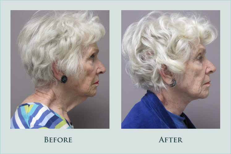 face necklift case before after picture