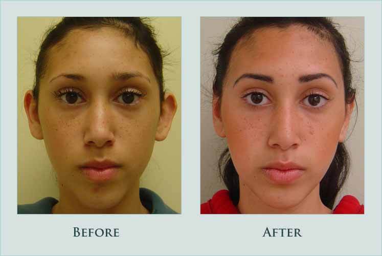 face otoplasty case before after picture