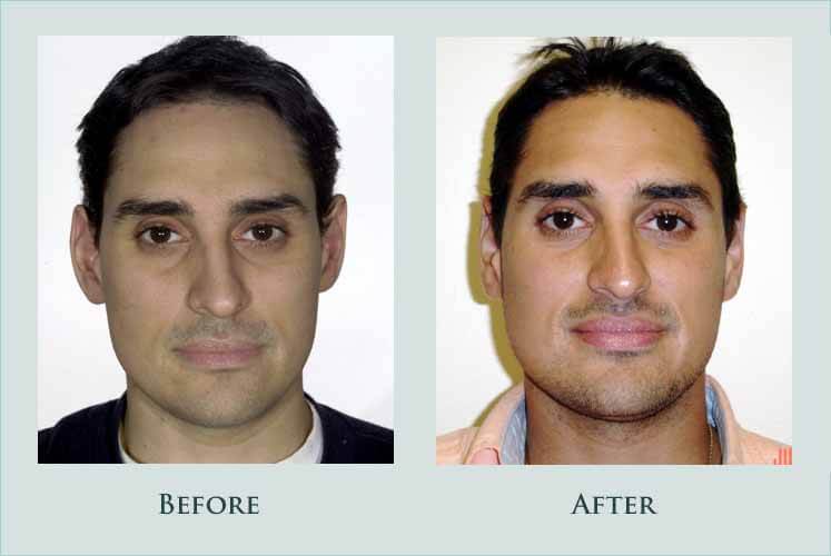 Before/after photos of procedure performed by Dr. Caroline Min - This is a young man who wished to have his ears pinned back slightly. His ears were only minimally protrusive but he liked to wear his hair very short and felt that the shorter hair made his ears look more prominent. He is shown 6 months after surgery.