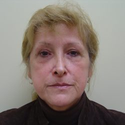 Fillers Before & After Patient #705