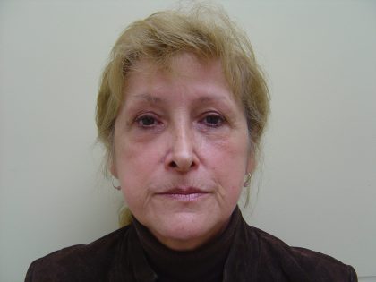 Fillers Before & After Patient #705