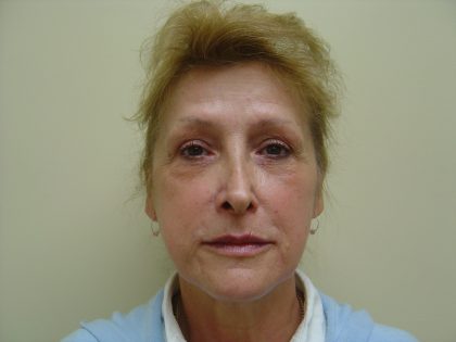 Fillers Before & After Patient #705