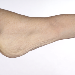 Arm Lift Before & After Patient #1748