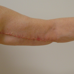 Arm Lift Before & After Patient #1748