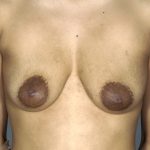 Breast Augmentation and Lift Before & After Patient #1700