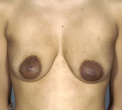 Breast Augmentation and Lift Before & After Patient #1700