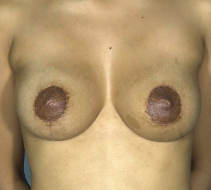 Breast Augmentation and Lift Before & After Patient #1700