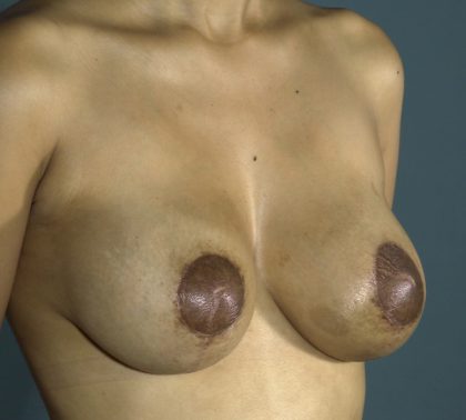 Breast Augmentation and Lift Before & After Patient #1700