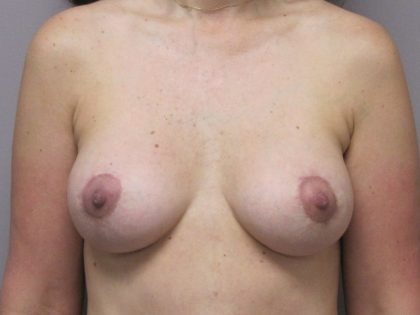 Breast Augmentation and Lift Before & After Patient #1699