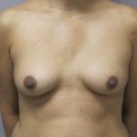 Breast Augmentation and Lift Before & After Patient #1698