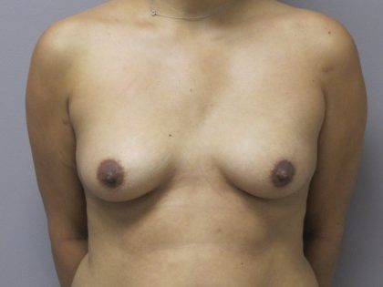 Breast Augmentation and Lift Before & After Patient #1698