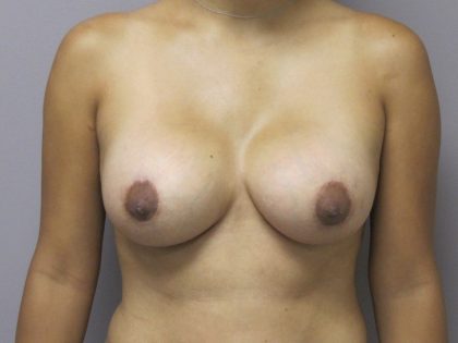 Breast Augmentation and Lift Before & After Patient #1698