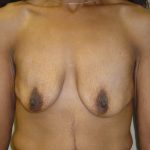 Breast Augmentation and Lift Before & After Patient #1697