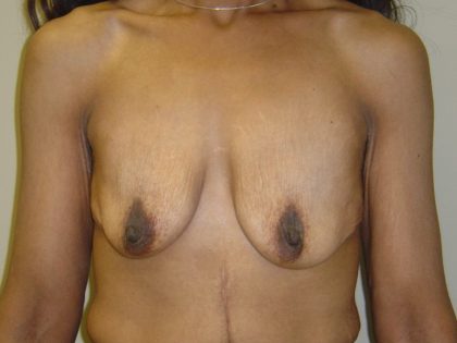 Breast Augmentation and Lift Before & After Patient #1697