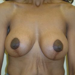 Breast Augmentation and Lift Before & After Patient #1697