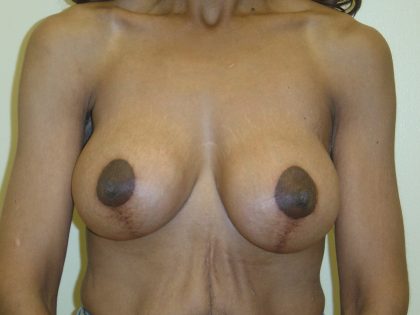 Breast Augmentation and Lift Before & After Patient #1697