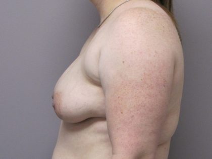 Breast Augmentation and Lift Before & After Patient #1696