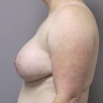 Breast Augmentation and Lift Before & After Patient #1696