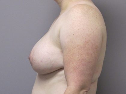 Breast Augmentation and Lift Before & After Patient #1696