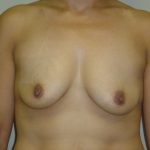 Breast Augmentation and Lift Before & After Patient #1695