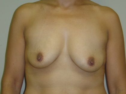 Breast Augmentation and Lift Before & After Patient #1695