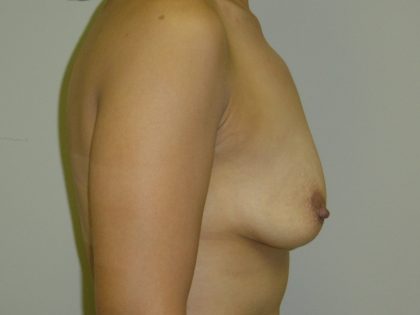 Breast Augmentation and Lift Before & After Patient #1695