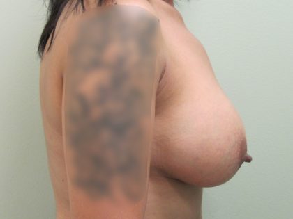 Breast Augmentation and Lift Before & After Patient #1695