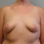 Breast Augmentation Before & After Patient #1685