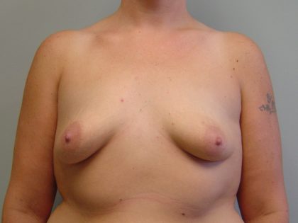 Breast Augmentation Before & After Patient #1685