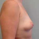 Breast Augmentation Before & After Patient #1685