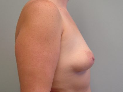 Breast Augmentation Before & After Patient #1685