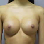 Breast Augmentation Before & After Patient #1684