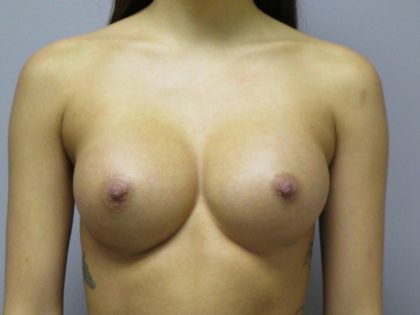 Breast Augmentation Before & After Patient #1684