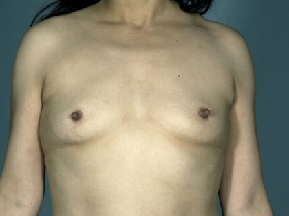 Breast Augmentation Before & After Patient #1683