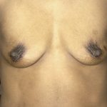 Breast Augmentation Before & After Patient #1682