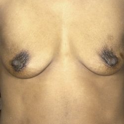 Breast Augmentation Before & After Patient #1682