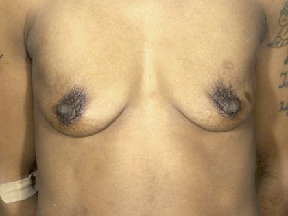 Breast Augmentation Before & After Patient #1682