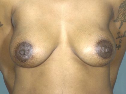 Breast Augmentation Before & After Patient #1682