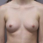 Breast Augmentation Before & After Patient #1692