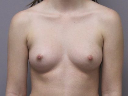 Breast Augmentation Before & After Patient #1692