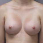 Breast Augmentation Before & After Patient #1692