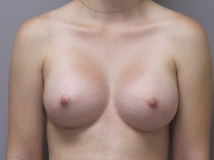 Breast Augmentation Before & After Patient #1692