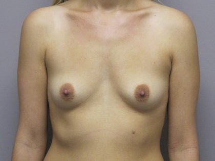 Breast Augmentation Before & After Patient #1691