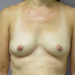 Breast Augmentation Before & After Patient #1688