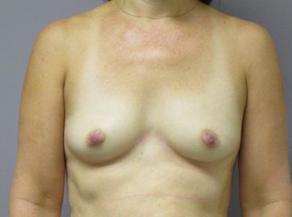 Breast Augmentation Before & After Patient #1688