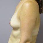 Breast Augmentation Before & After Patient #1688