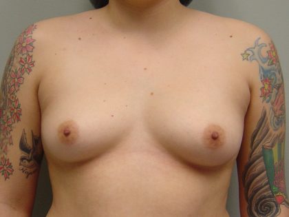 Breast Augmentation Before & After Patient #1687