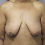 Breast Lift Before & After Patient #1714